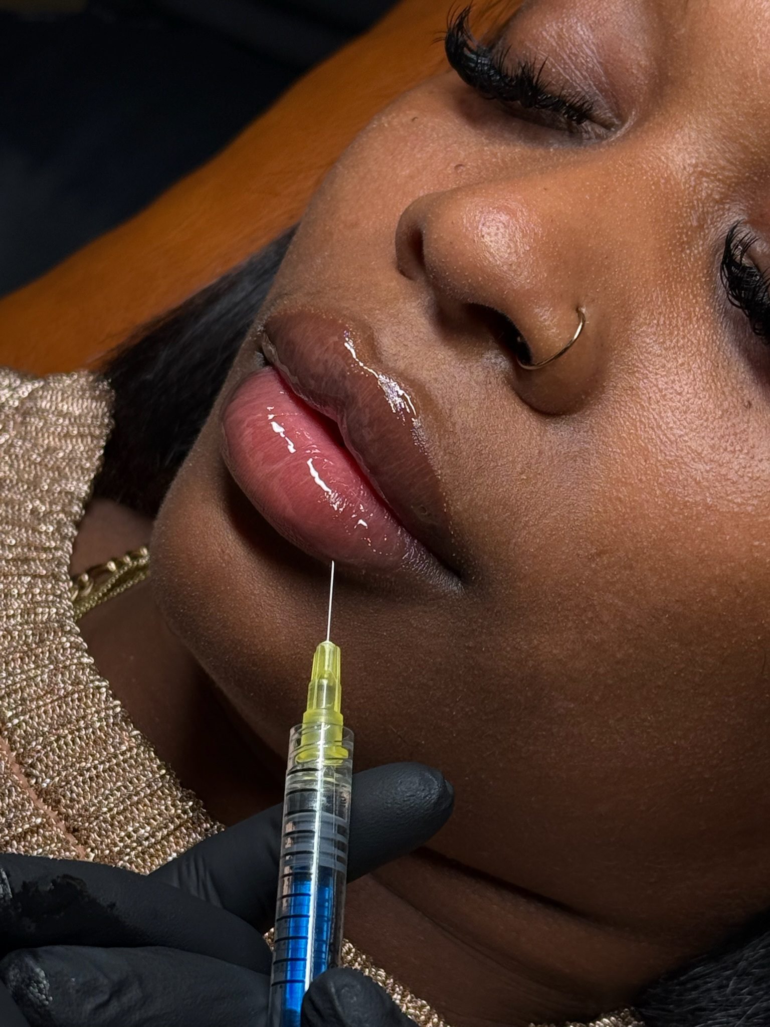 Close-up of a cosmetic lip injection procedure.
